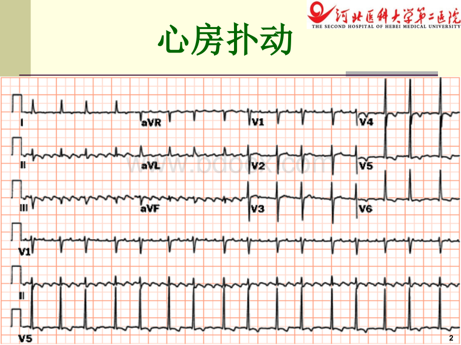 心电图基础5-心律失常3优质PPT.ppt_第2页