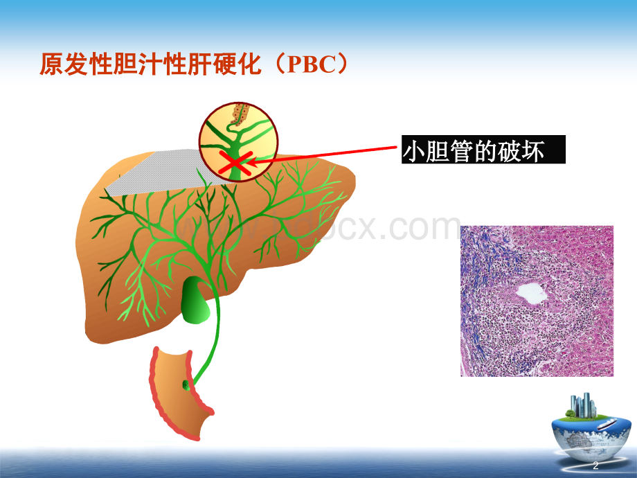 原发性胆汁性肝硬化诊治共识解读优质PPT.ppt_第2页