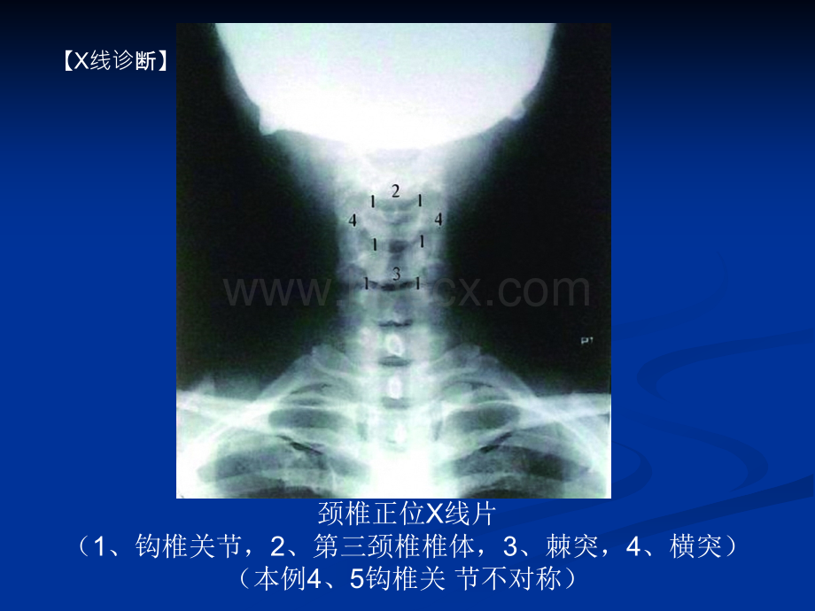 整脊影像学诊断全面详细优质PPT.ppt_第2页