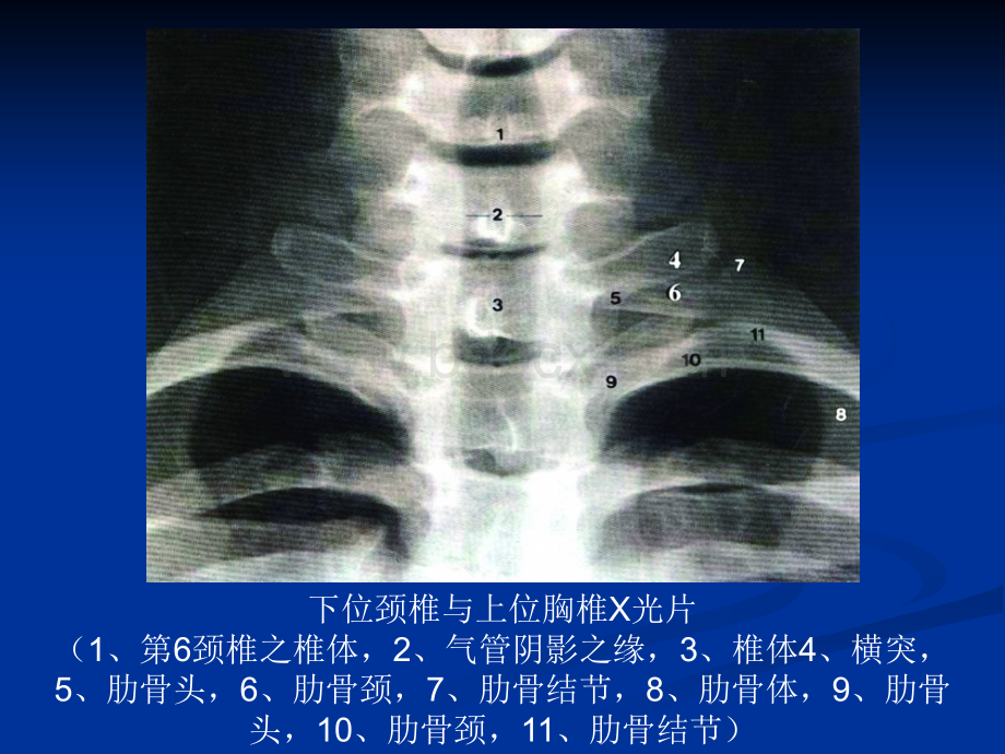 整脊影像学诊断全面详细优质PPT.ppt_第3页