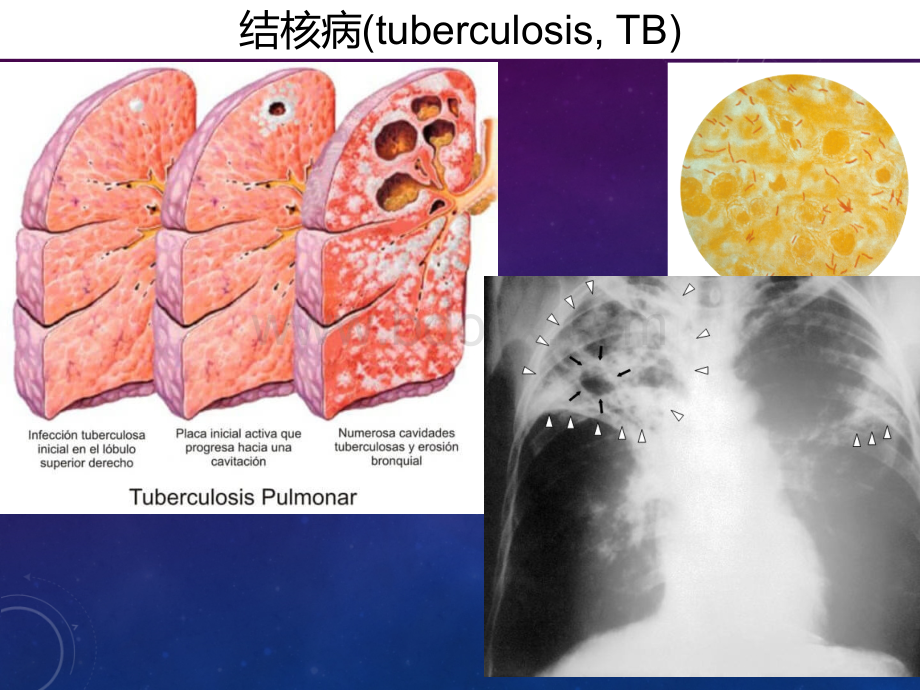 45抗结核病麻风病.pptx_第3页