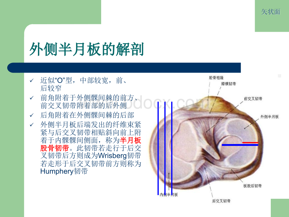 膝关节半月板损伤MRI诊断ppt_精品文档.ppt_第3页