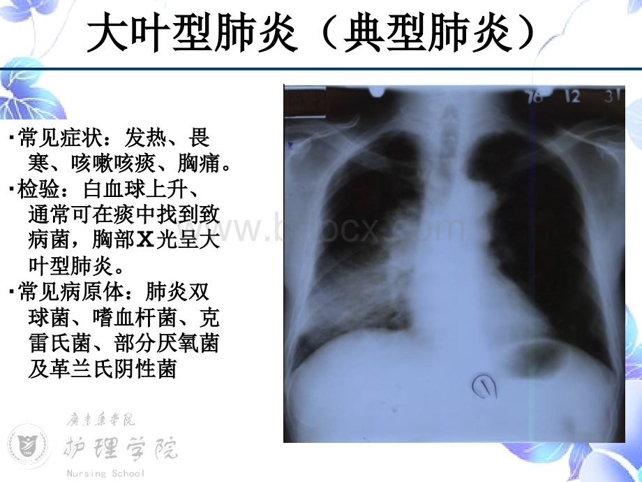 SARS病人的护理.ppt_第3页