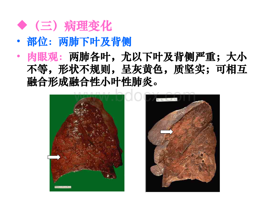 大叶性肺炎小叶性肺炎间质性肺炎下部分PPT文档格式.ppt_第3页