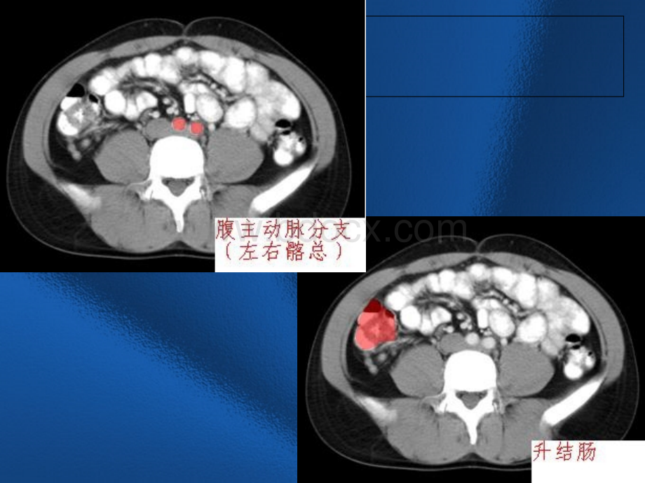 盆腔内常见疾病CT诊断.ppt_第3页