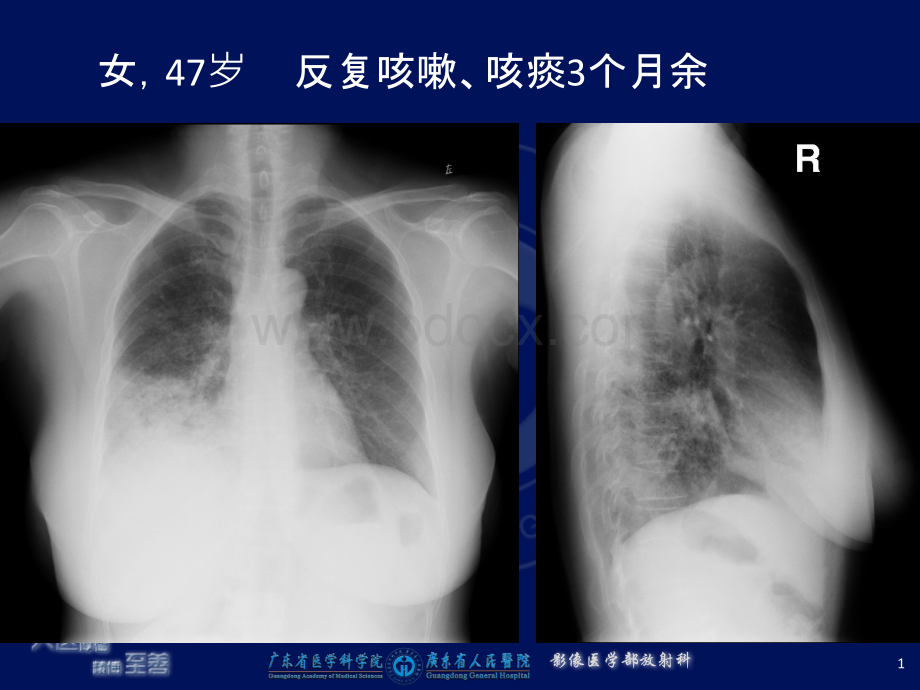 浸润型黏液性腺癌.ppt_第1页