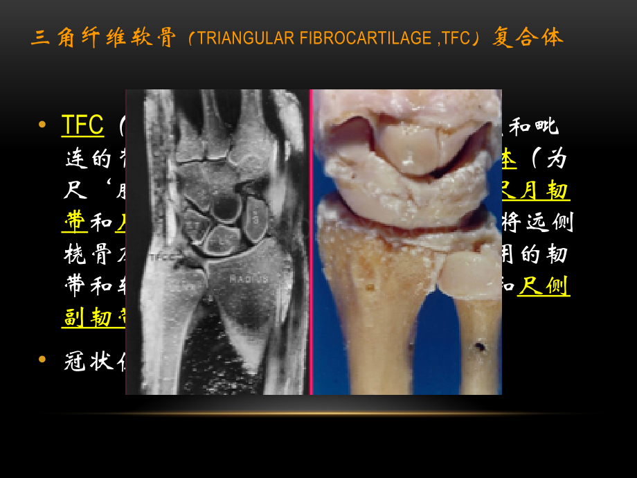 腕关节疾病的MRI诊断和解剖_精品文档.pptx_第2页