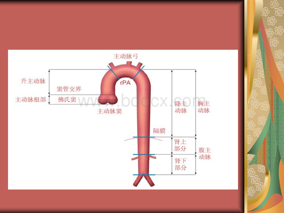 主动脉夹层的诊断与护理.ppt_第3页