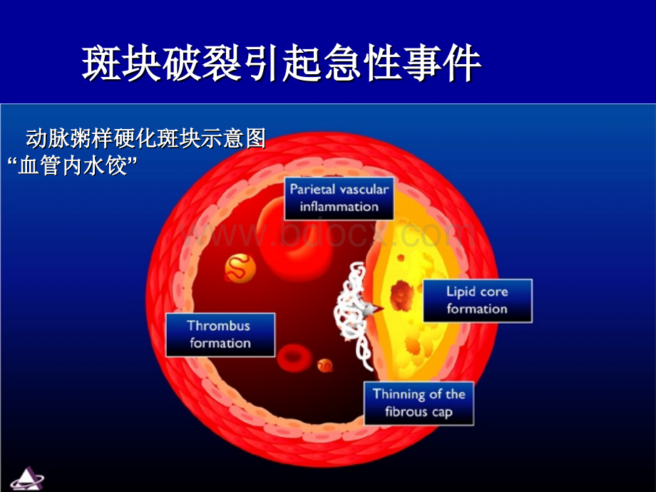 立普妥稳定逆转斑块研究荟萃--王海波.ppt_第3页