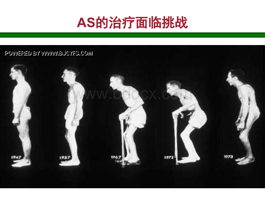 益赛普治疗强直性脊柱炎PPT课件下载推荐.ppt_第2页