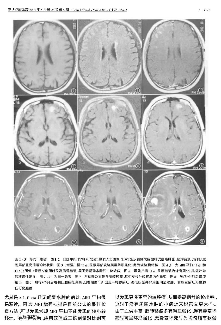 肺癌脑转移的MRI特点1.pdf_第3页