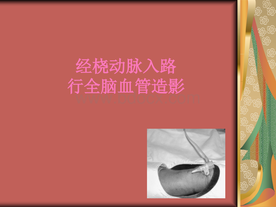 经桡动脉DSA.ppt