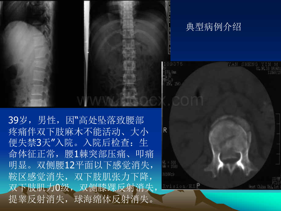 脊柱和骨盆骨折--正式版PPT课件下载推荐.ppt_第3页