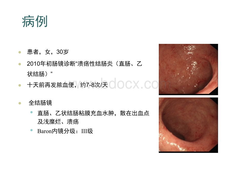 溃疡性结肠炎治疗规范.ppt_第2页