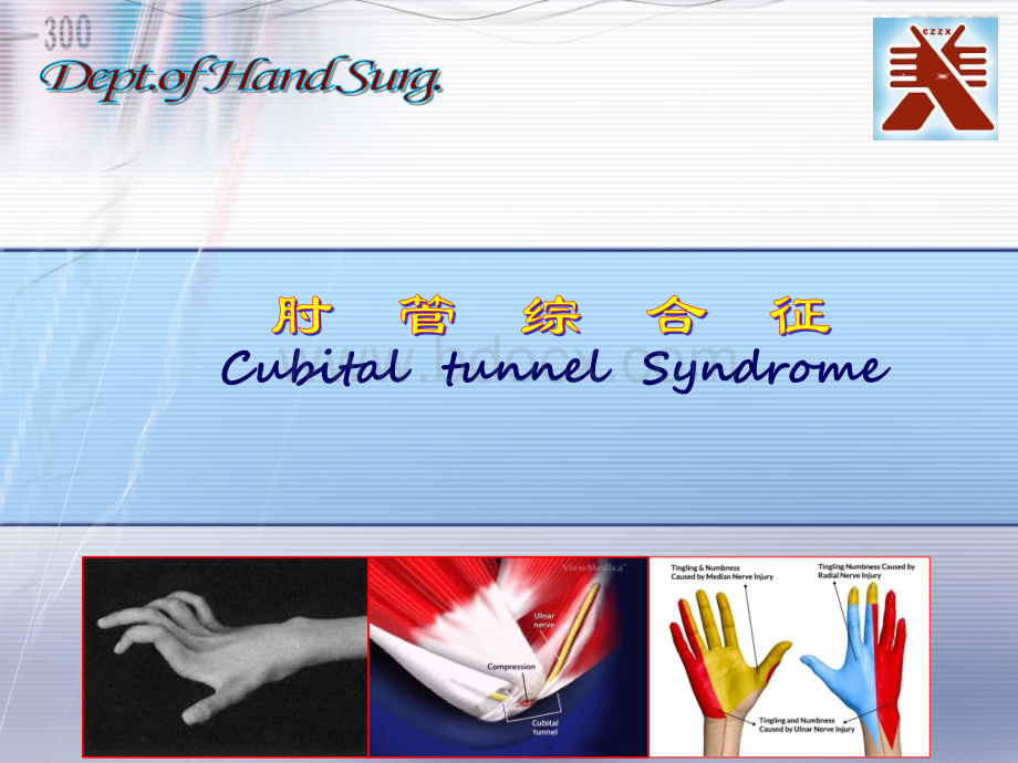 肘管综合症PPT文件格式下载.pptx