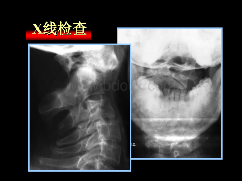 寰枢椎脱位的临床分型和外科治疗.ppt_第3页