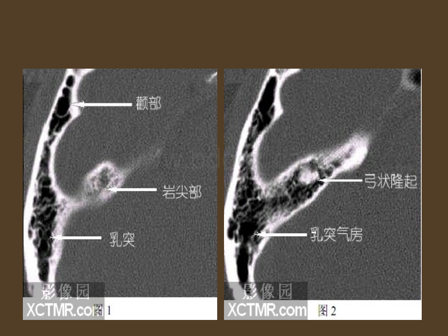 爱爱医资源-耳部最详细CT解剖.ppt_第2页