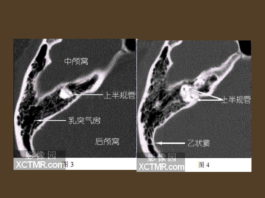 爱爱医资源-耳部最详细CT解剖.ppt_第3页