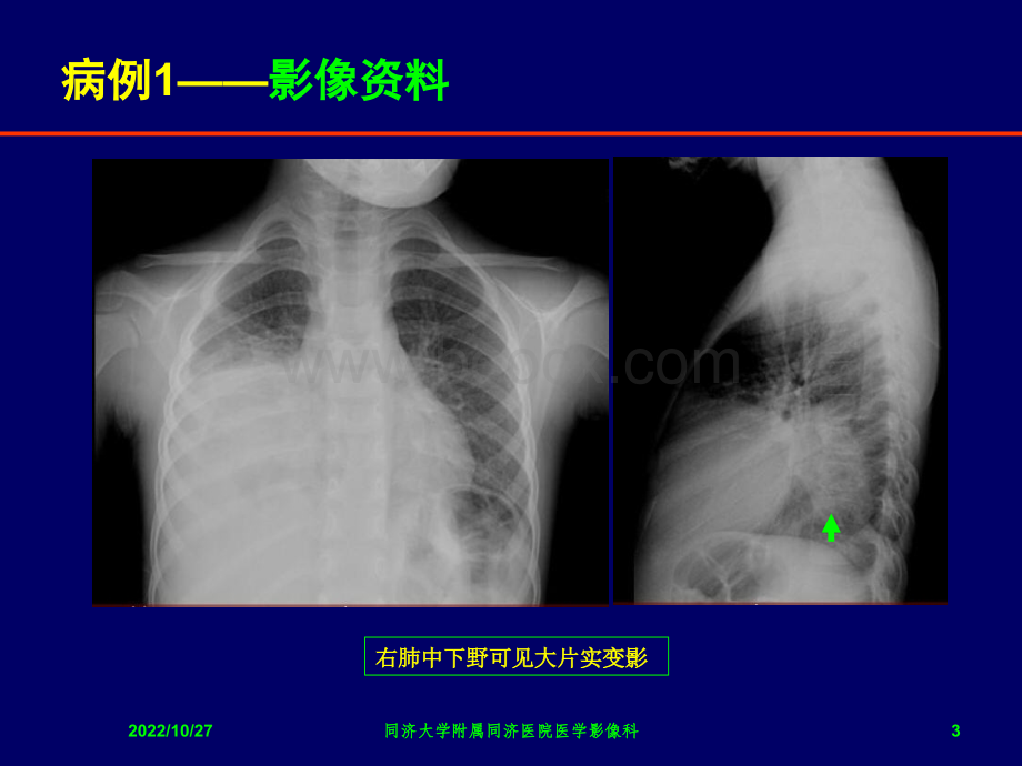 胸部少见罕见疾病影像诊断PPT格式课件下载.ppt_第3页