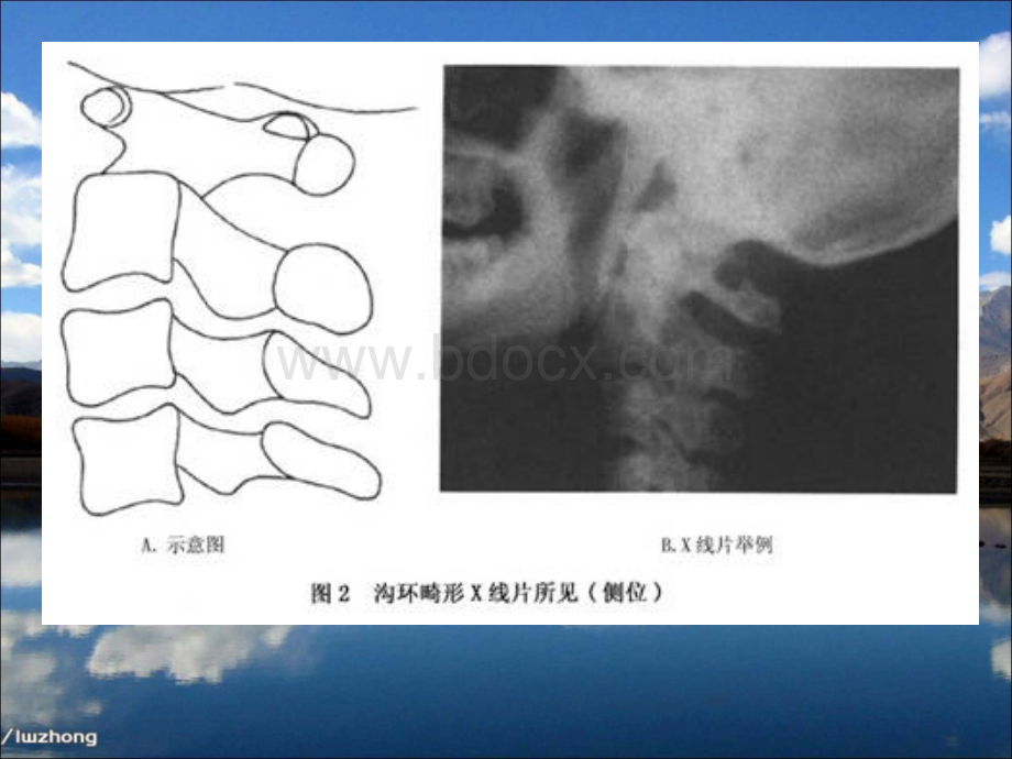 寰椎后桥PPT文档格式.ppt_第3页