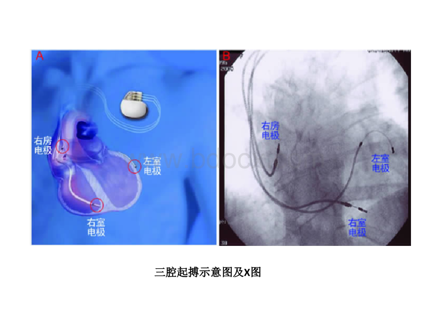 三腔起搏器心电图优质PPT.pptx_第2页