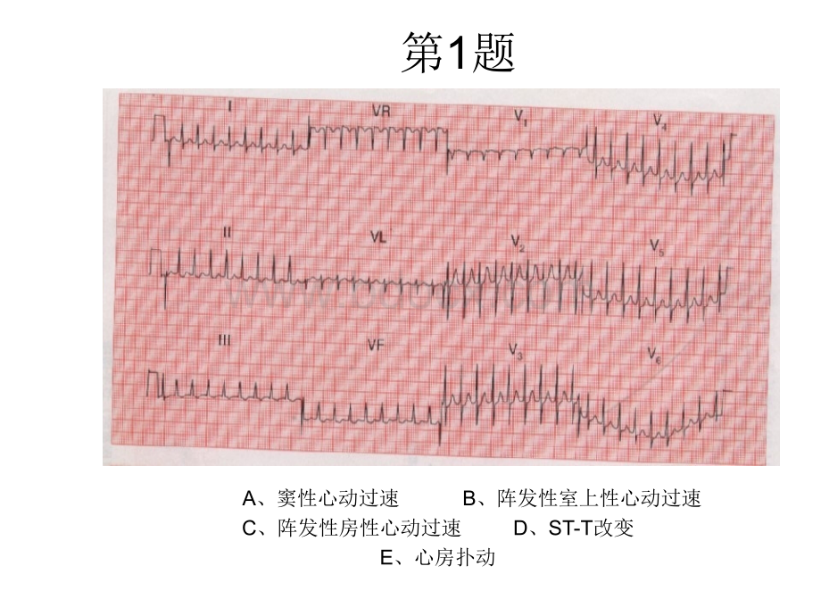 心电图考核题.ppt_第1页