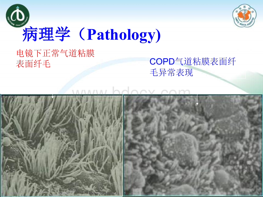 慢性支气管炎109班PPT资料.ppt_第3页