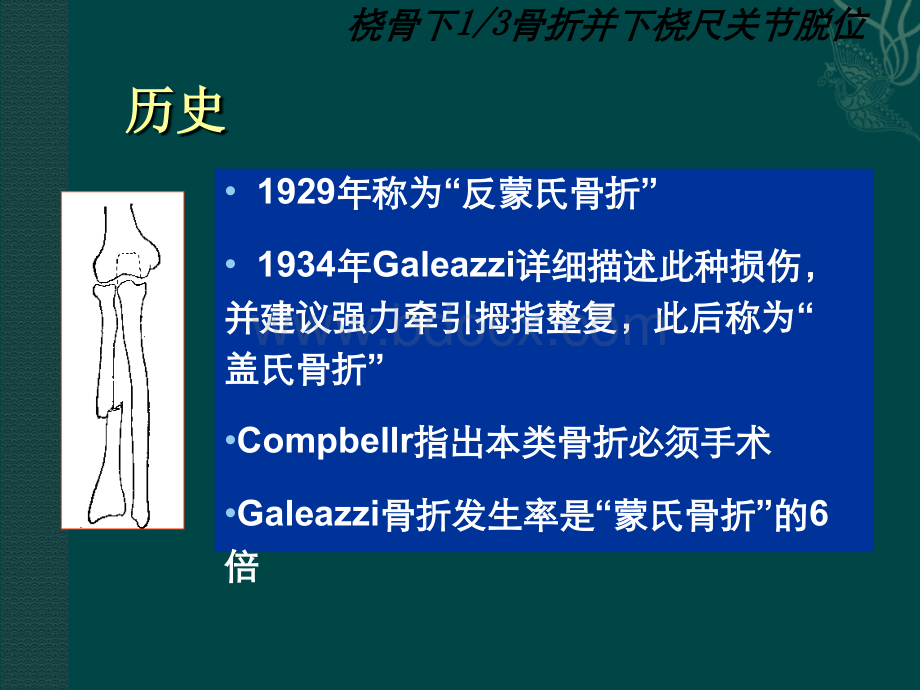 盖氏骨折PPT资料.ppt_第3页