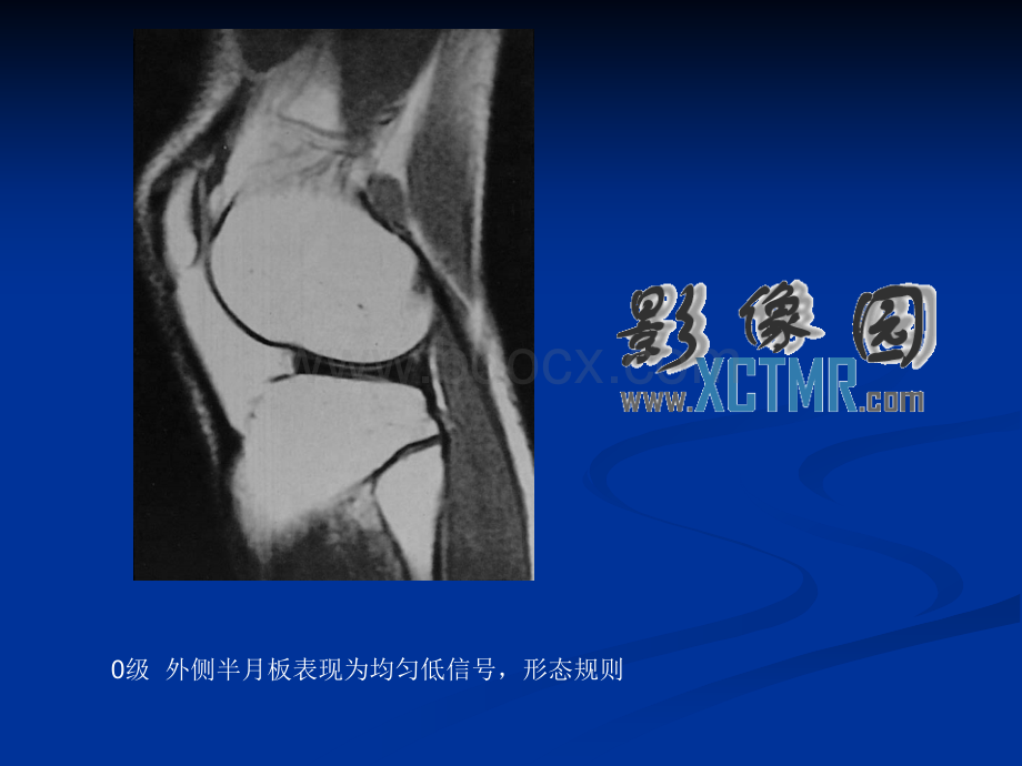 膝关节半月板病变MRI病例图片及分析_精品文档.ppt_第1页