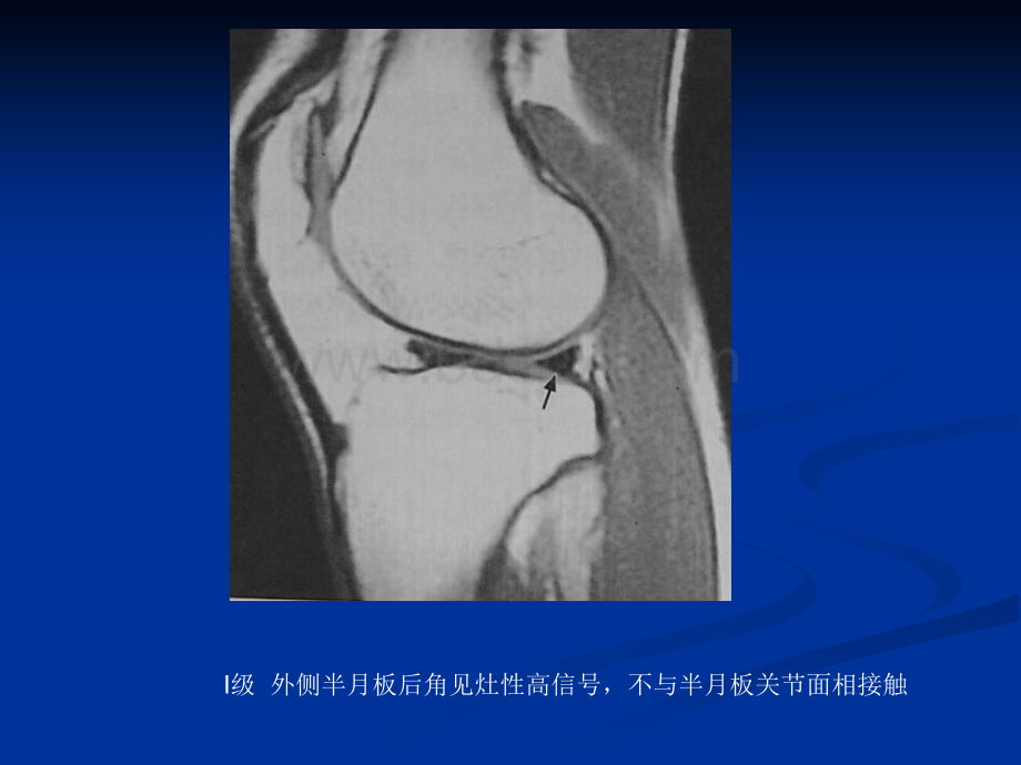 膝关节半月板病变MRI病例图片及分析_精品文档.ppt_第2页