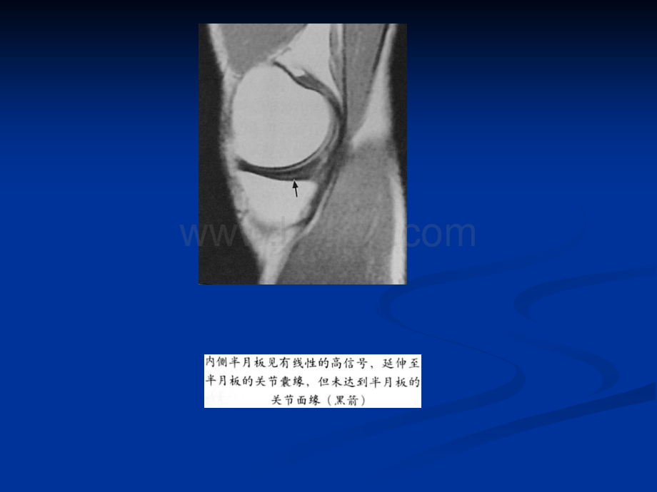 膝关节半月板病变MRI病例图片及分析_精品文档.ppt_第3页