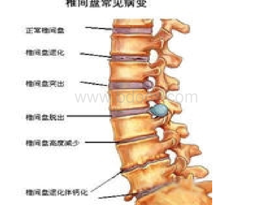 学会怎样看腰椎间盘突出CT和MRI磁共振.ppt_第2页