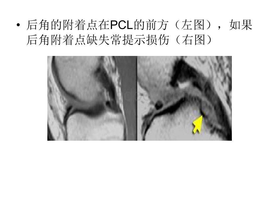 半月板的影像学表现PPT格式课件下载.ppt_第3页