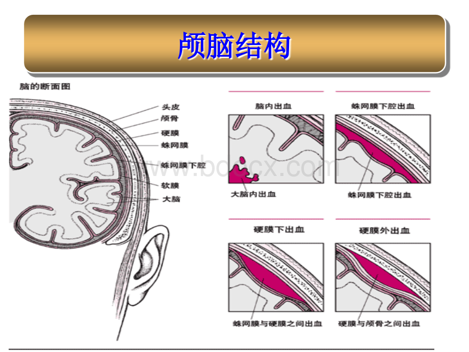 蛛网膜下腔出血的护理_精品文档.ppt_第3页