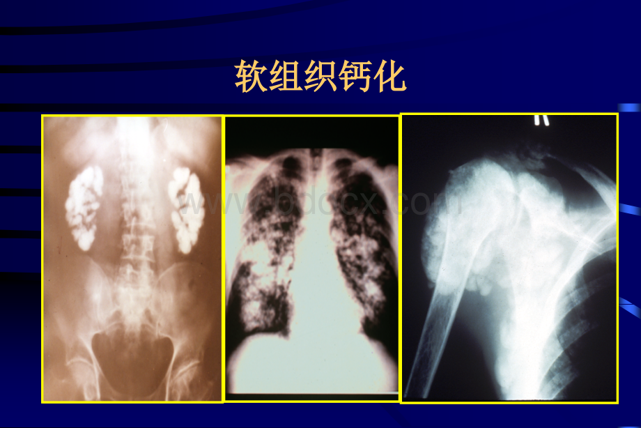 慢性肾脏病时的钙磷代谢异常及骨病-王少泽.ppt_第3页