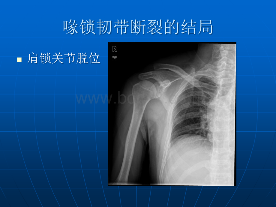 带袢钢板与ETHIBOND缝线双束PPT资料.ppt_第2页