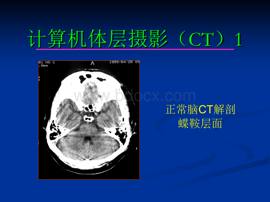 脑部疾病影像诊断学_精品文档.ppt_第3页