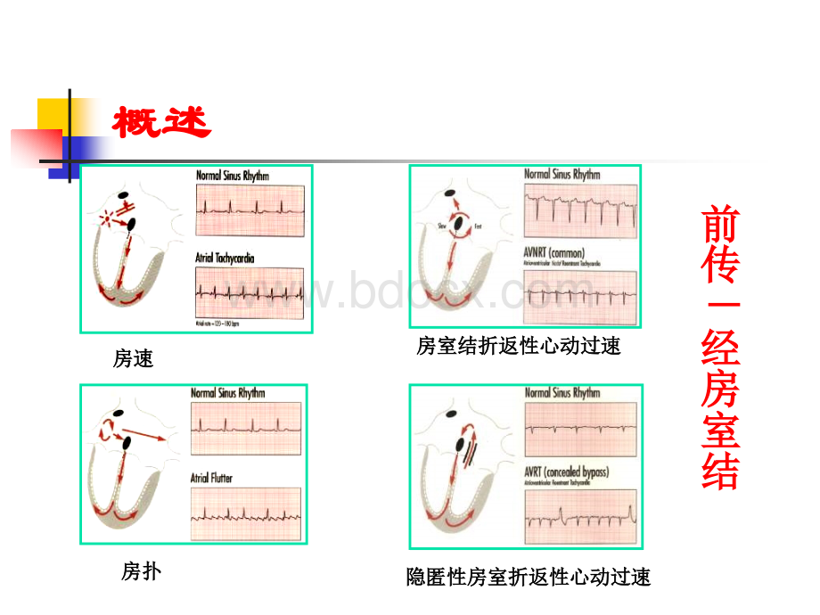 窄QRS波群鉴别.ppt_第3页