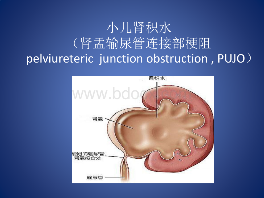 小儿肾积水PPT资料.pptx