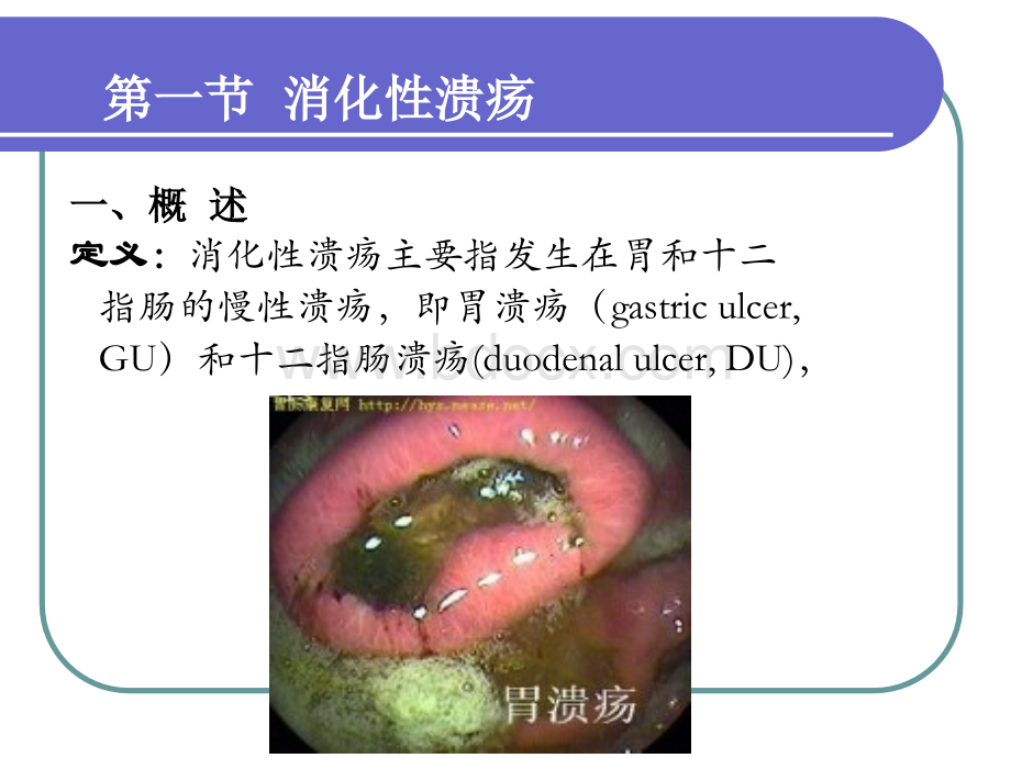 消化性溃疡的药物治疗111.ppt_第3页