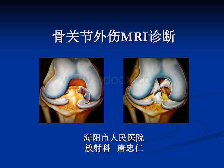 膝关节外伤MRI诊断--唐忠仁--定稿_精品文档.ppt_第1页