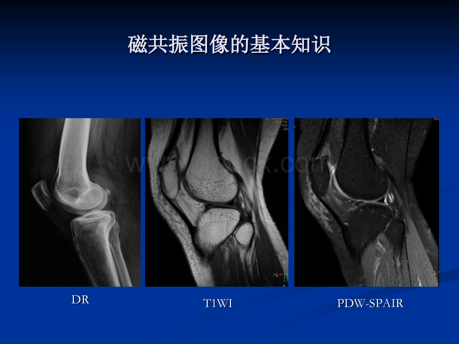 膝关节外伤MRI诊断--唐忠仁--定稿_精品文档.ppt_第2页