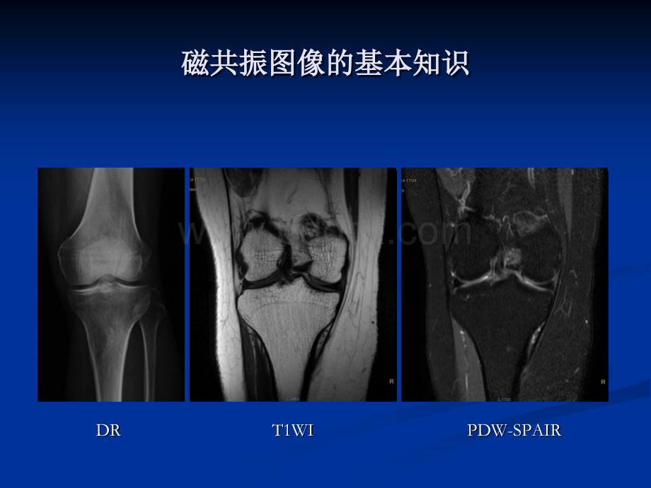 膝关节外伤MRI诊断--唐忠仁--定稿_精品文档.ppt_第3页