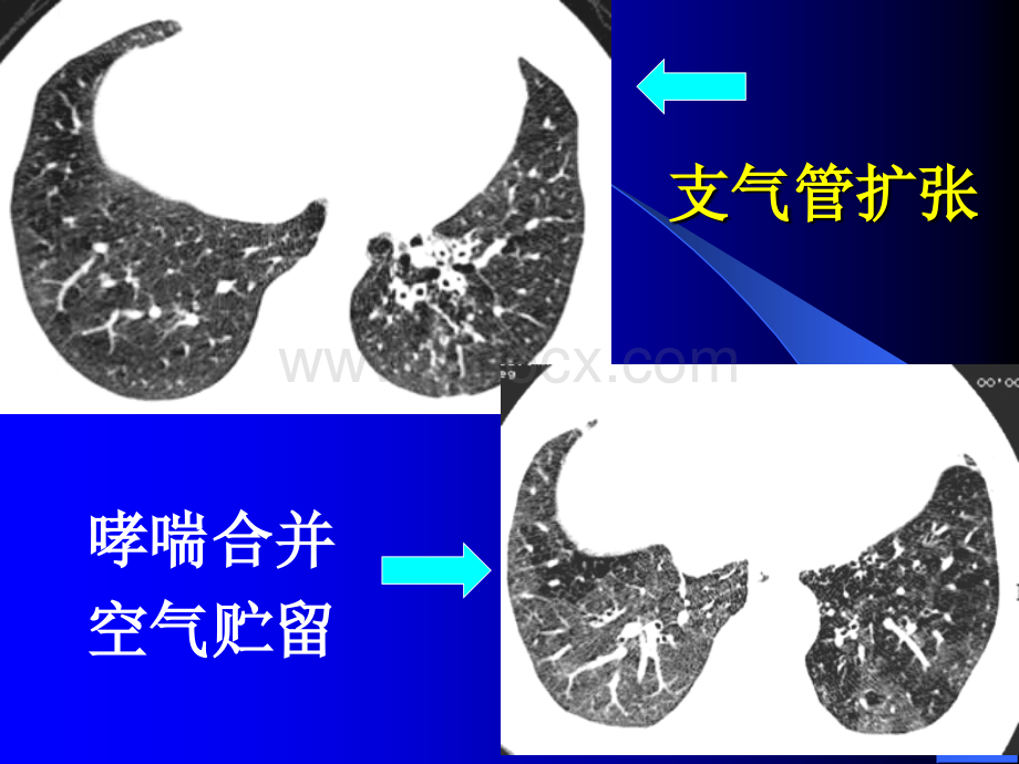 肺的CT功能性成像.ppt_第3页