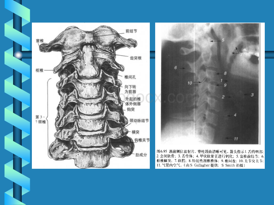 第65章腰腿痛和颈肩痛-颈椎病.ppt_第3页