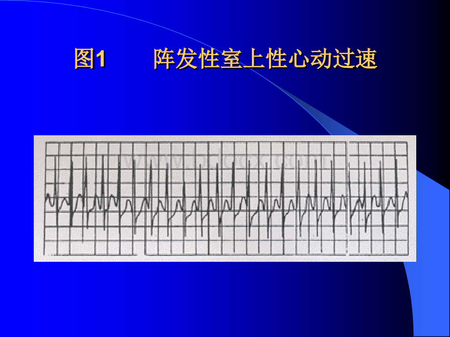 严重心律失常的诊断和急救处理.ppt_第3页