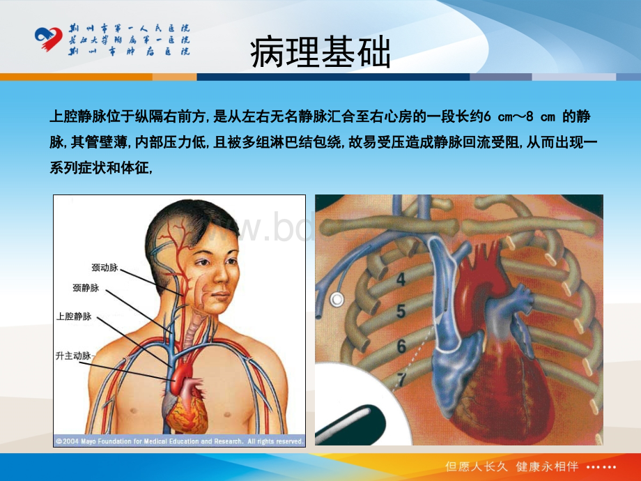 上腔静脉综合征PPT格式课件下载.ppt_第3页