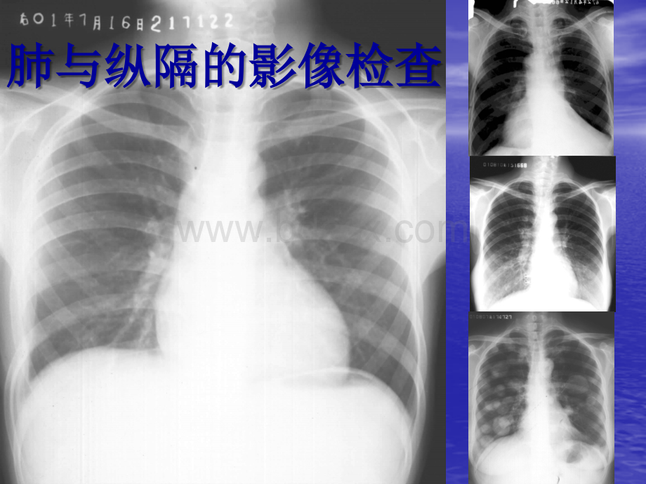 e诊断学看胸部CTPPT文件格式下载.ppt