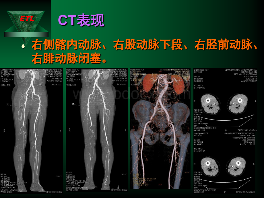 下肢动脉血栓诊疗PPT文档格式.ppt_第3页