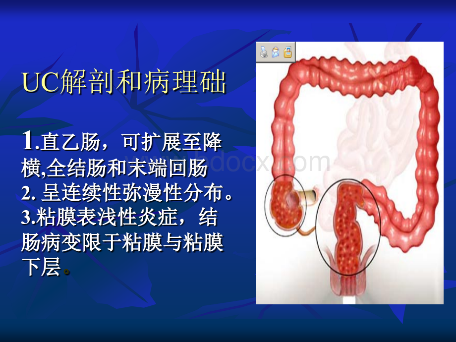 溃疡性结肠炎定义临床表现和治疗.ppt_第3页